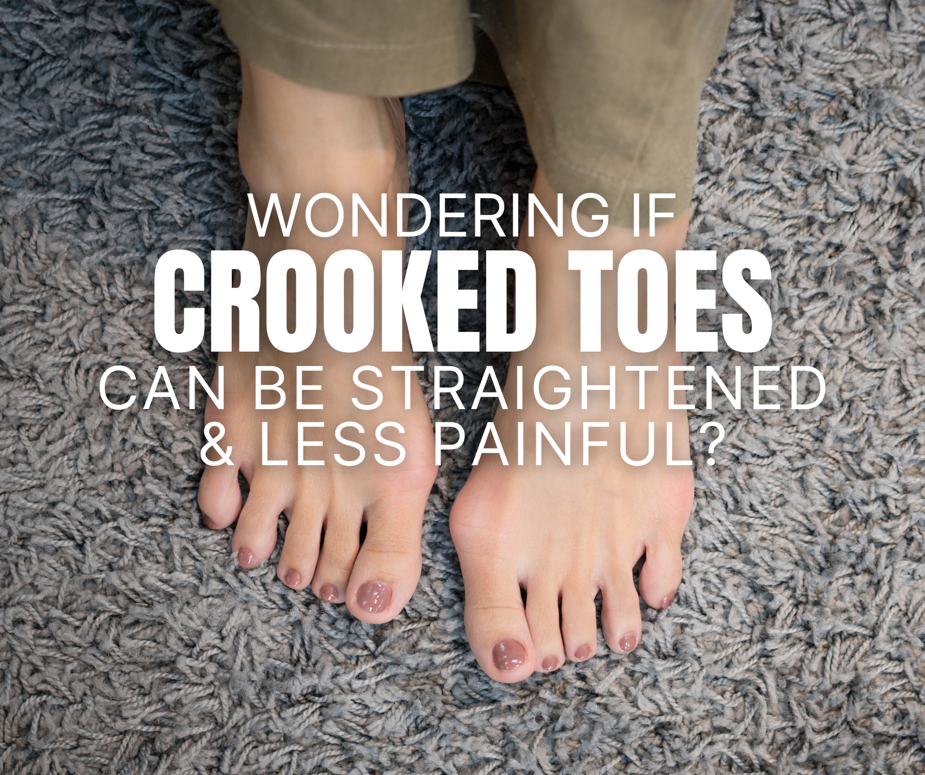 Crooded Toes Crooked Toes & Bunions: Relief Strategies & Alignment | My-Happy Feet ...