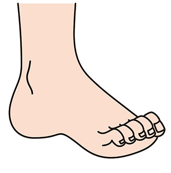 Hammertoe, what is it and how do you treat it – My-Happy Feet - The  Original Foot Alignment Socks